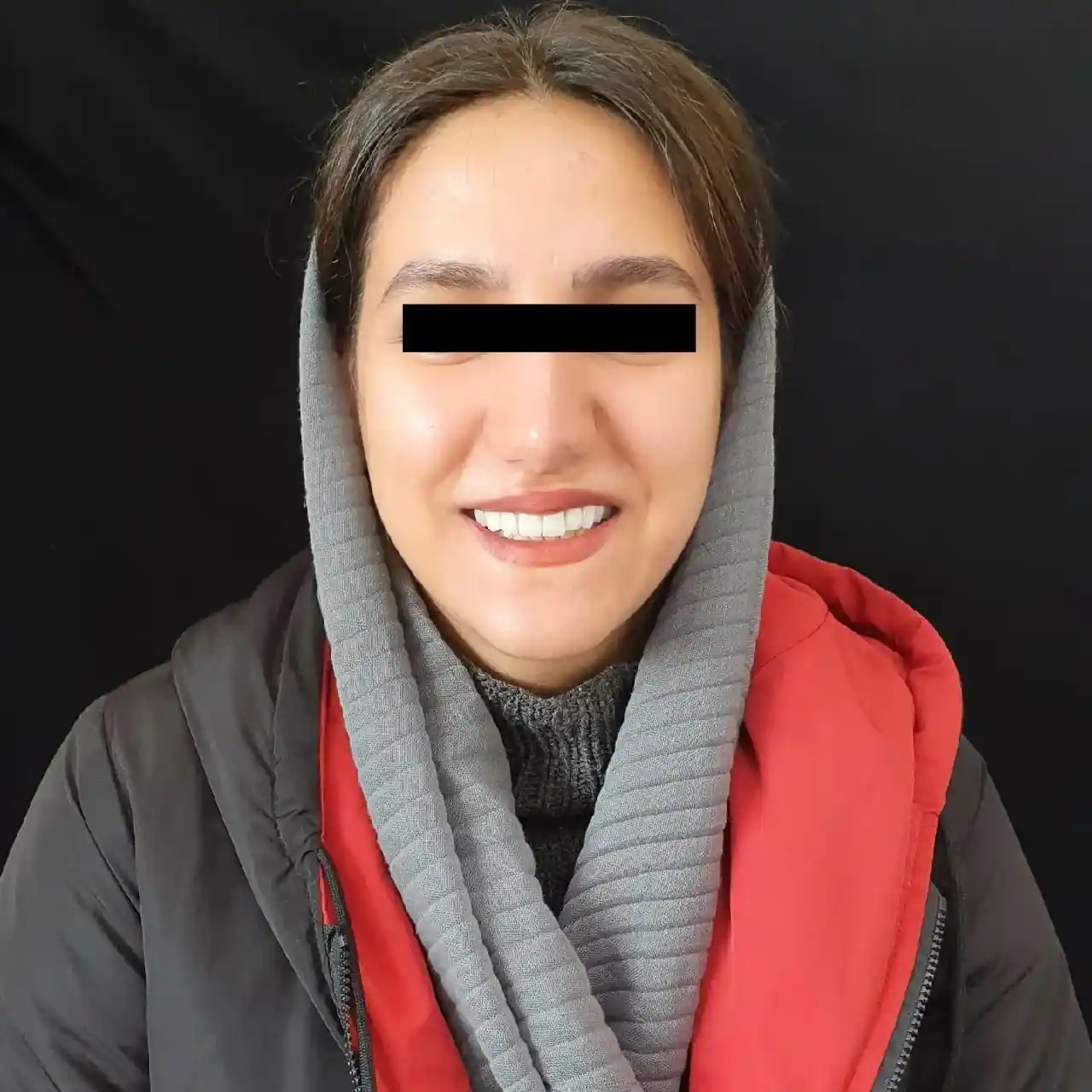 انجام ده واحد لمینیت و روکش سرامیکی