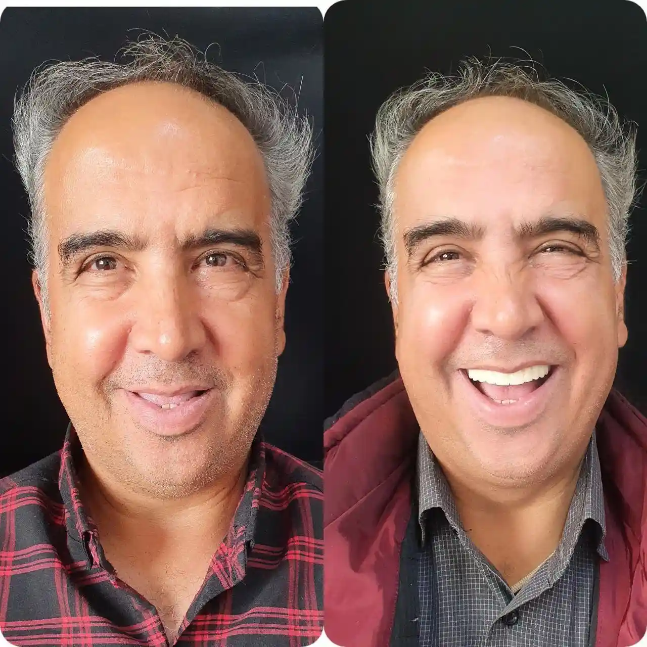 ایمپلنت درمانی بدون درد