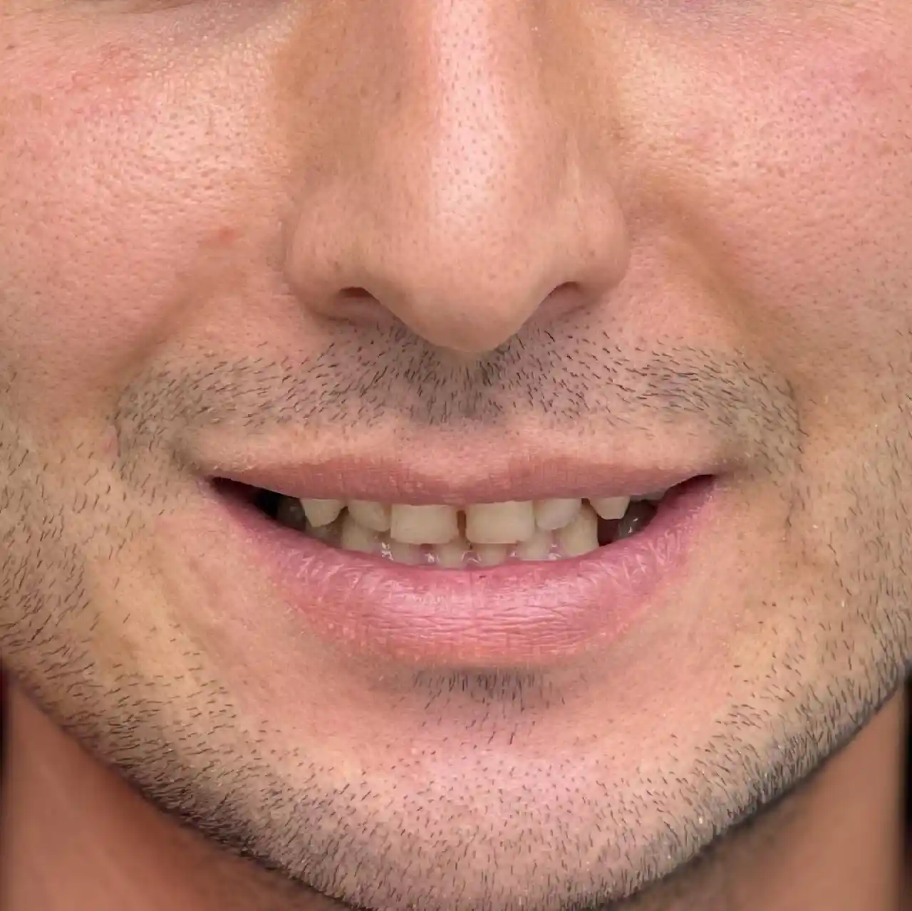 انجام روکش و لمینیت سرامیکی برای مراجعه کننده محترممون