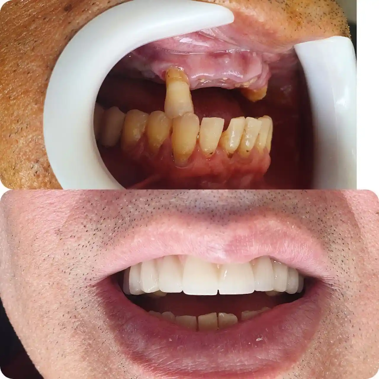 ایمپلنت درمانی بدون درد