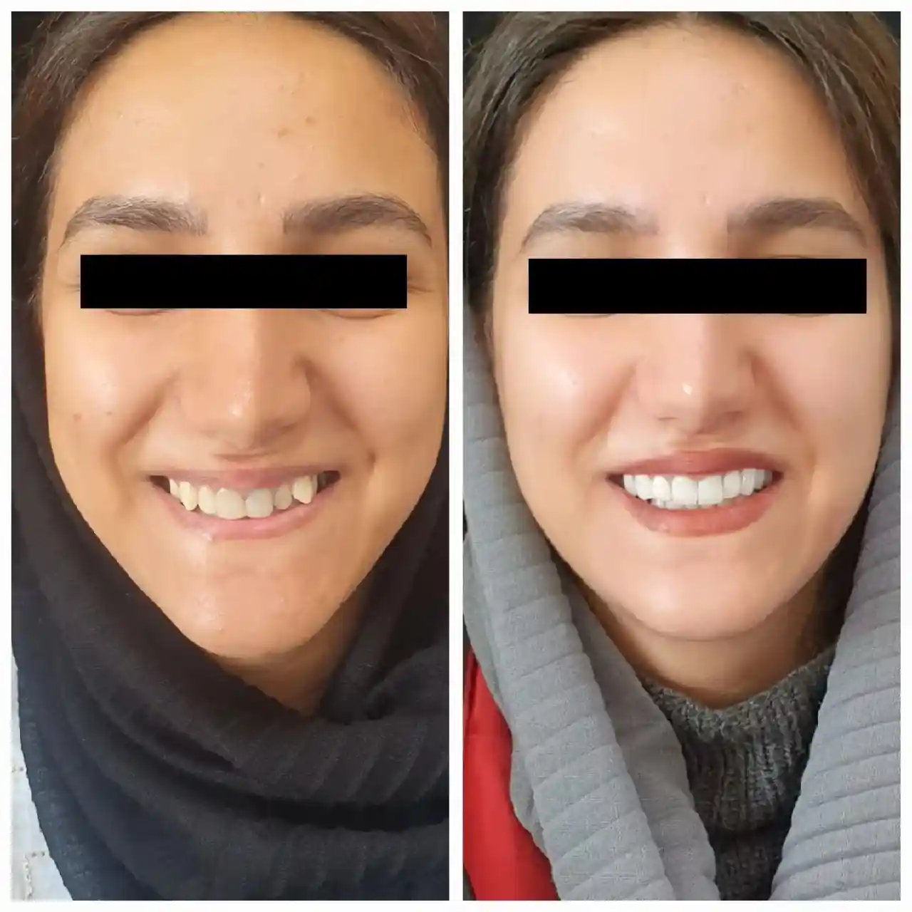 انجام ده واحد لمینیت و روکش سرامیکی