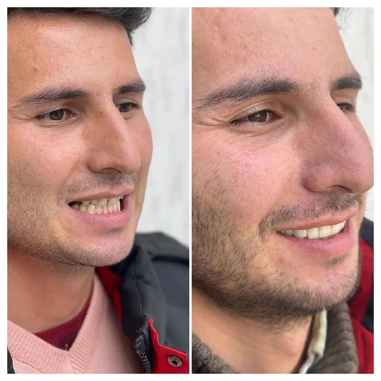 انجام روکش و لمینیت سرامیکی برای مراجعه کننده محترممون