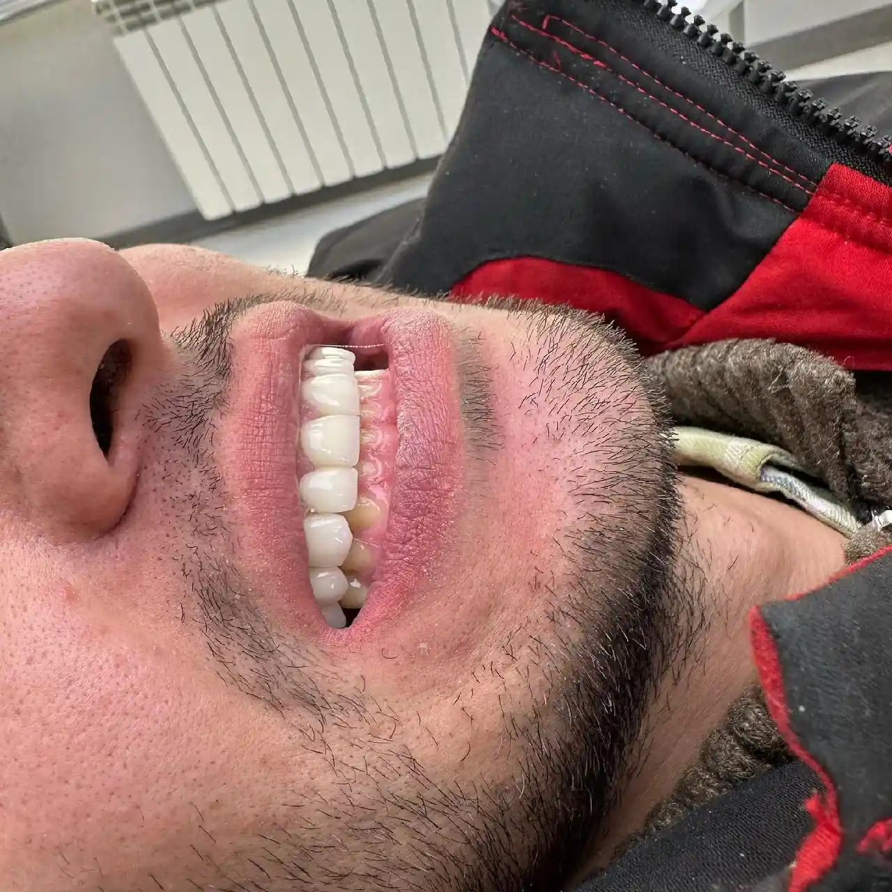 انجام روکش و لمینیت سرامیکی برای مراجعه کننده محترممون