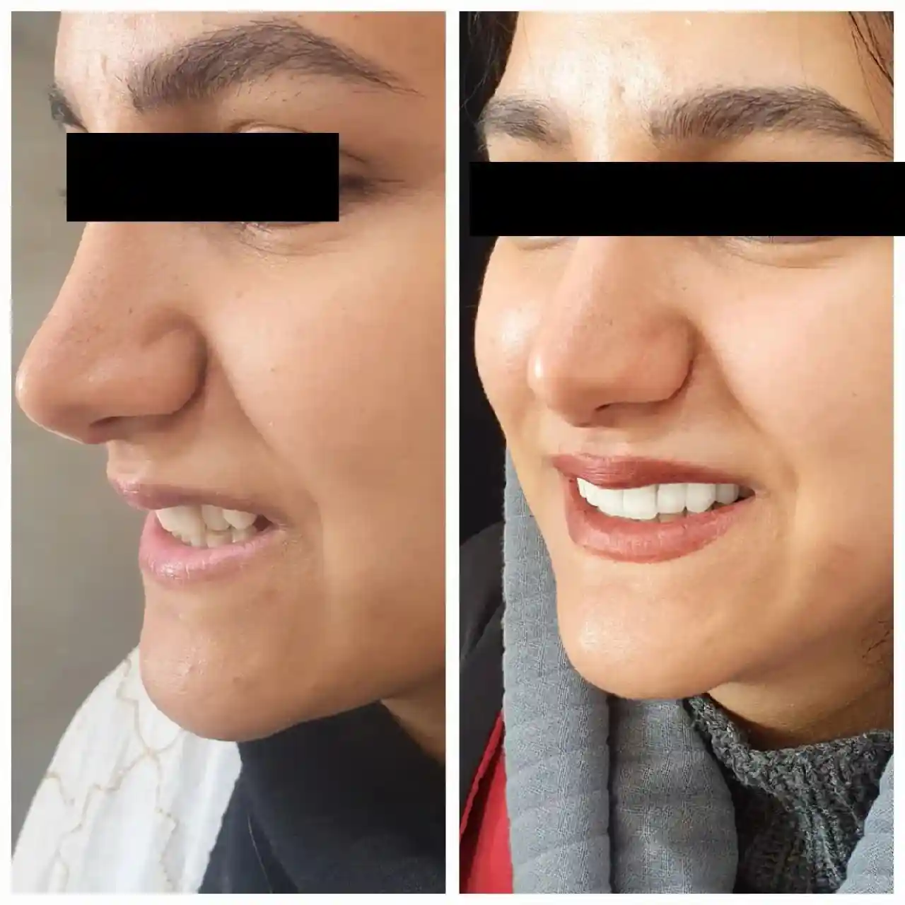 انجام ده واحد لمینیت و روکش سرامیکی