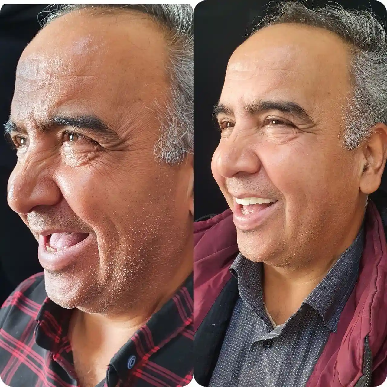 ایمپلنت درمانی بدون درد