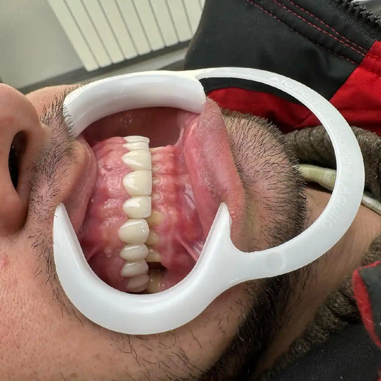 انجام روکش و لمینیت سرامیکی برای مراجعه کننده محترممون