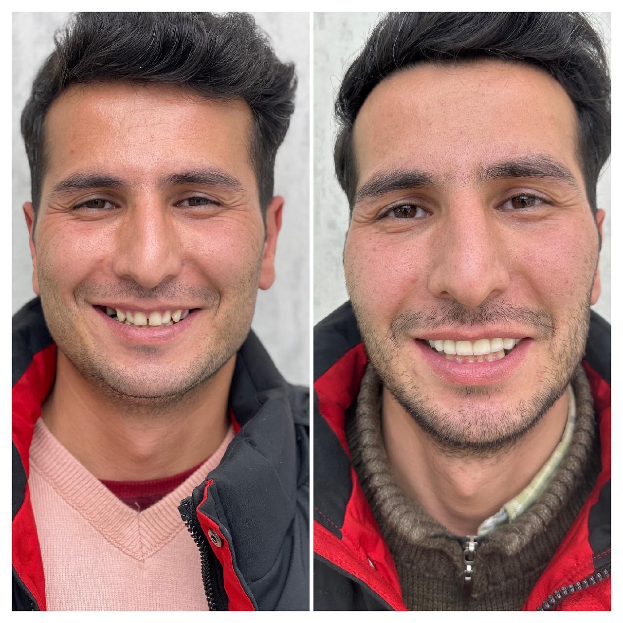 انجام روکش و لمینیت سرامیکی برای مراجعه کننده محترممون