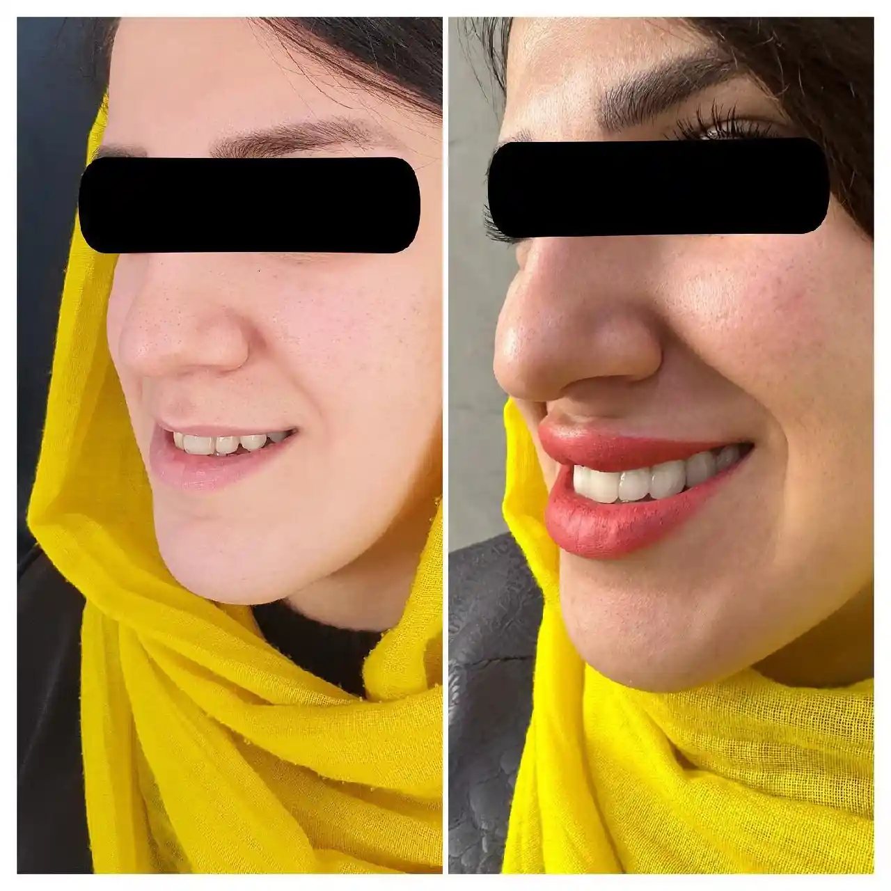 انجام درمان ترکیبی سیزده واحد لمینیت و روکشهای سرامیکی