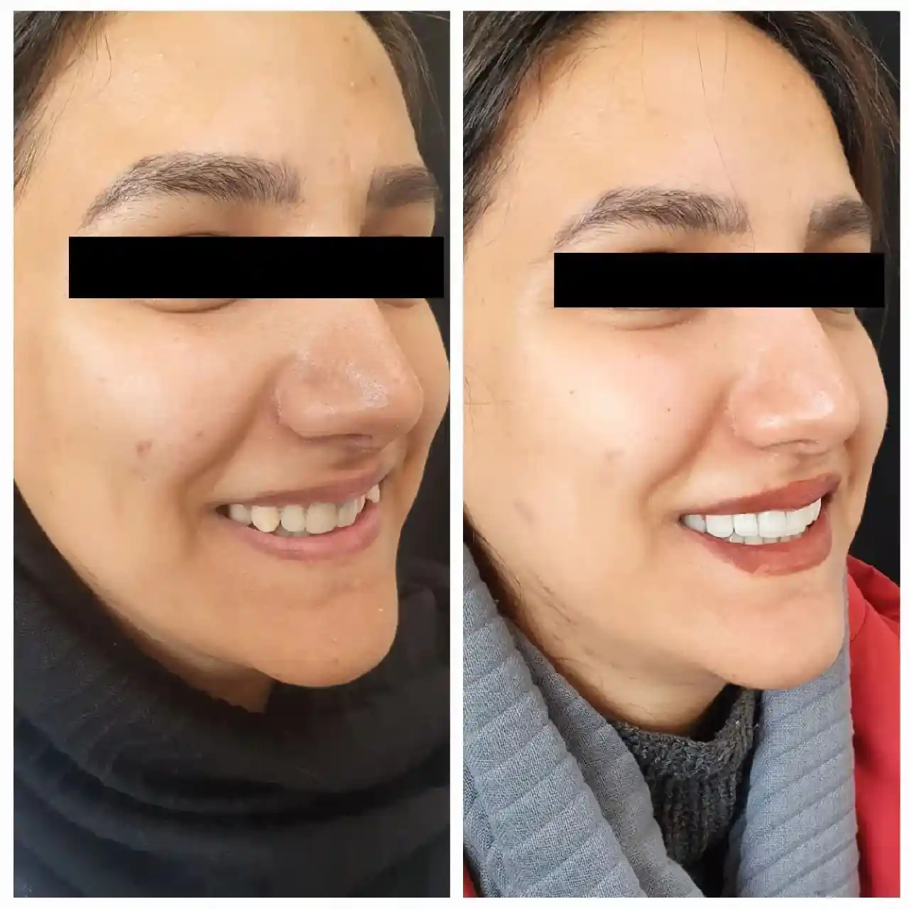 انجام ده واحد لمینیت و روکش سرامیکی