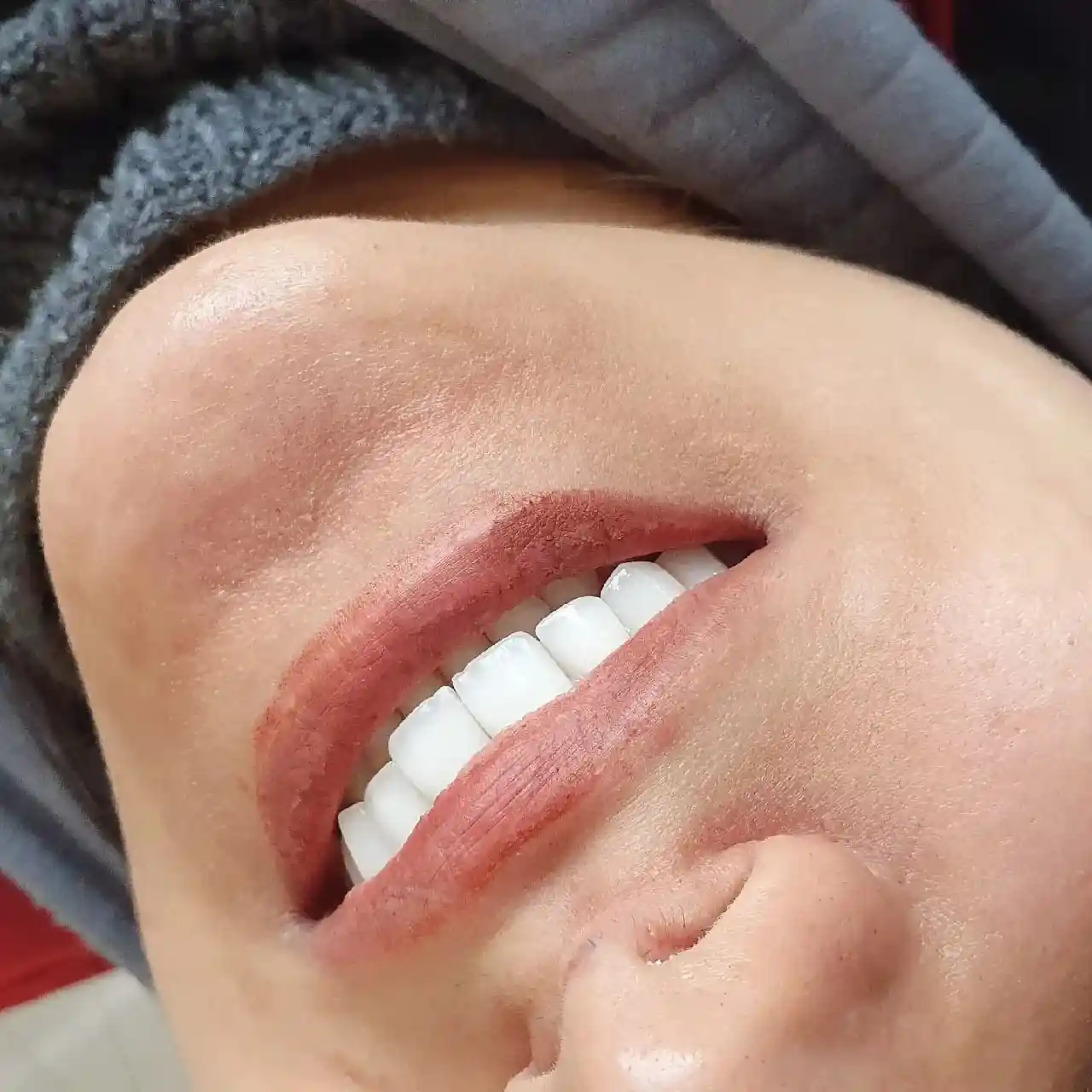 انجام ده واحد لمینیت و روکش سرامیکی