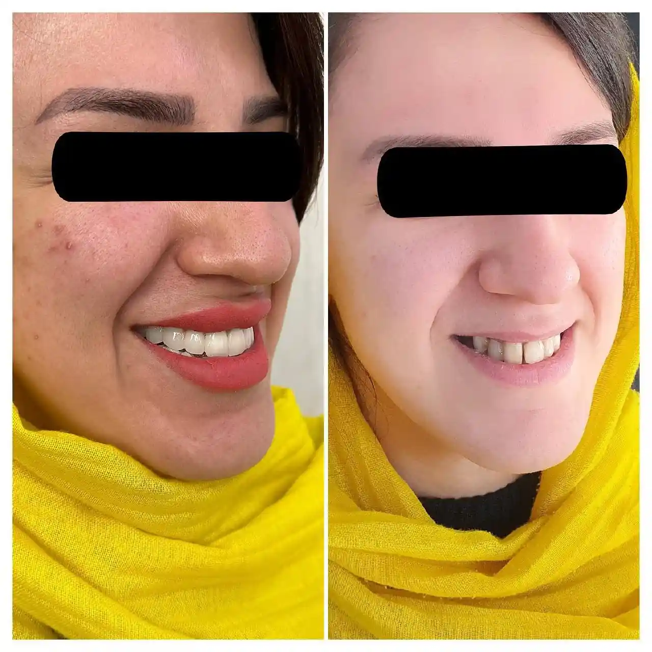 انجام درمان ترکیبی سیزده واحد لمینیت و روکشهای سرامیکی