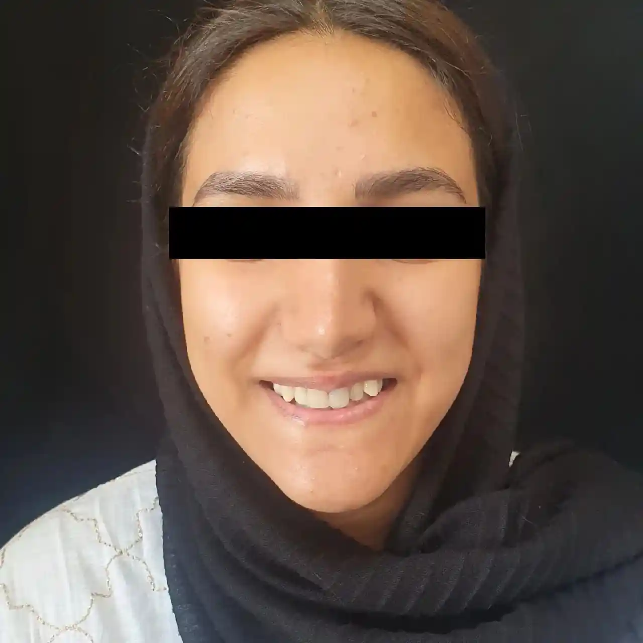 انجام ده واحد لمینیت و روکش سرامیکی