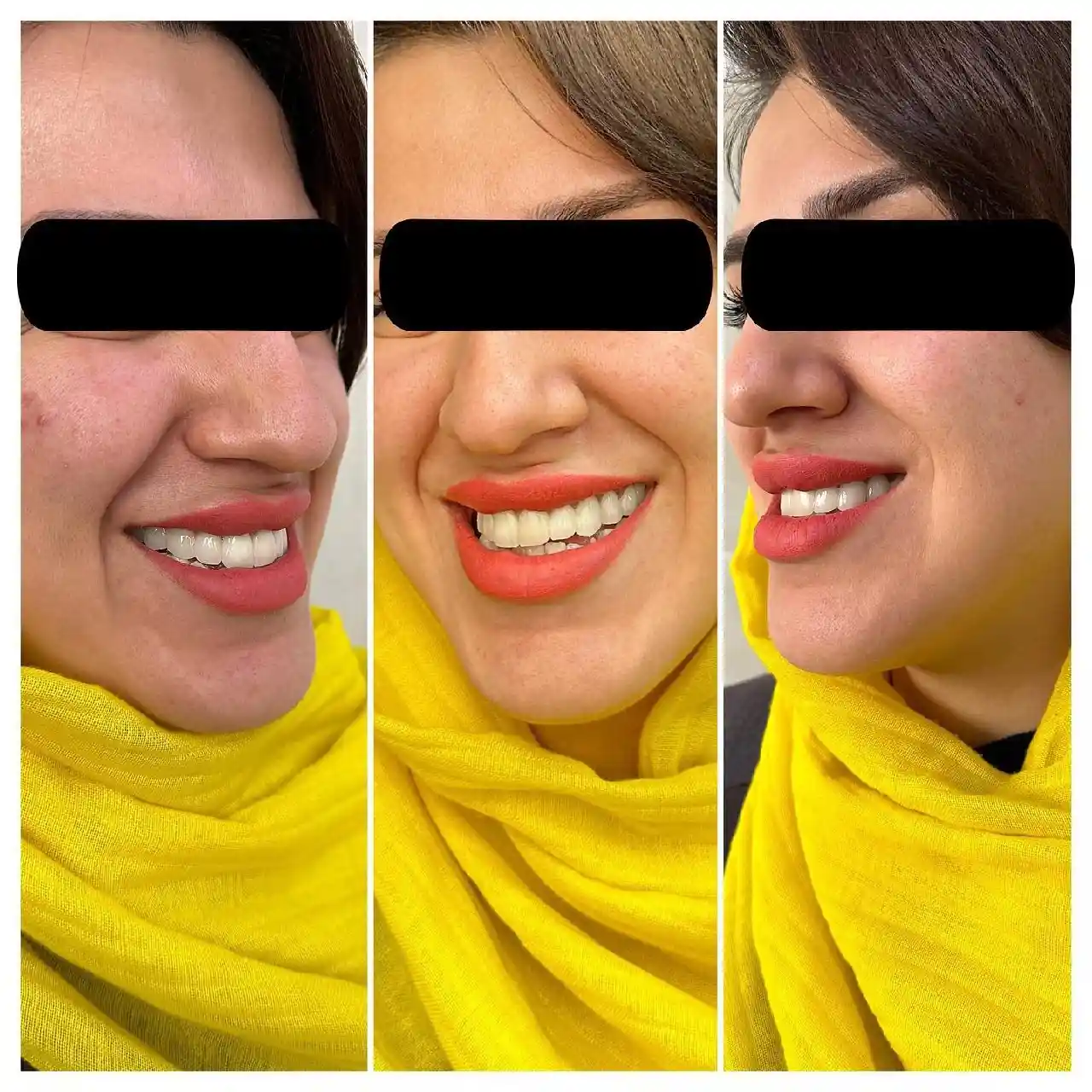 انجام درمان ترکیبی سیزده واحد لمینیت و روکشهای سرامیکی